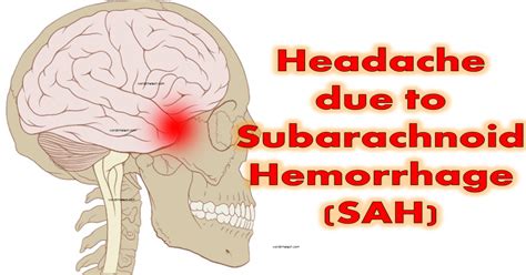 Subarachnoid Hemorrhage Headache Symptoms Treatments Causes ...