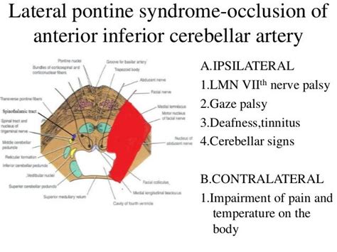 Medial Mid Pontine Syndrome - Captions Trending Update