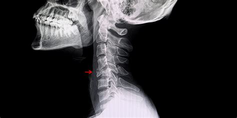 Resolving Compression Fractures with Kyphoplasty | Advanced Spine