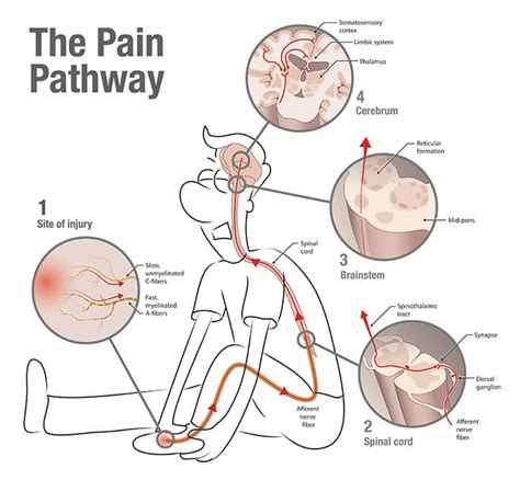 Chronic pain - All in my head? - PhysioPrescription