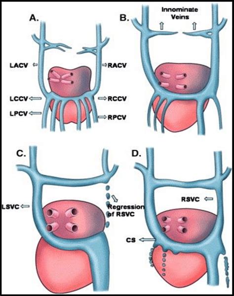 Developmental anatomy of the persistent left superior vena cava as ...