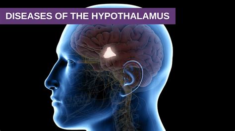 Diseases of the Hypothalamus - Genesis Gold - Hypothalamus