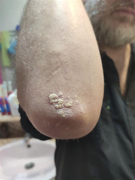 White bumps on elbow, any idea what it is? : r/SkincareAddicts