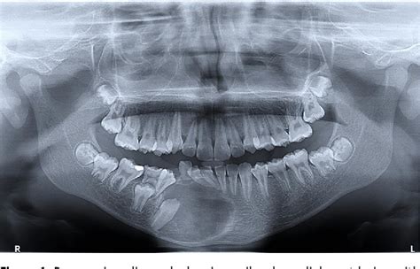 Figure 1 from Aggressive adenomatoid odontogenic tumor: an uncommon ...