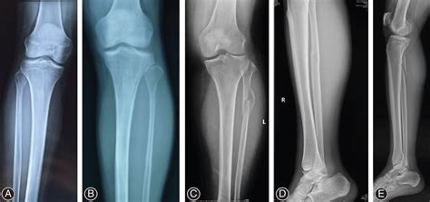 Manifestations of proximal fibular fractures. (A) Fibular neck ...