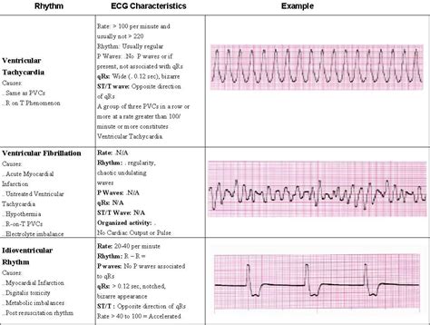 ACLS Rhythms pg 5 of 7 | Saving American Hearts, Inc. AHA ACLS BLS PALS ...