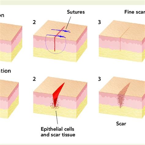 Difference in wound healing between primary and secondary intention ...