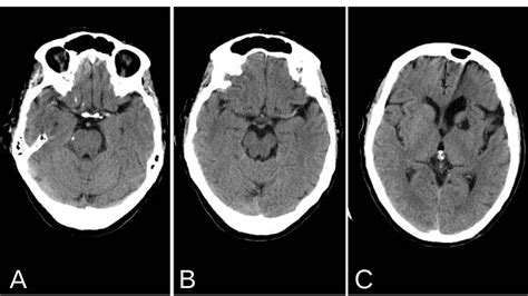 Left MCA Infarct with Hyperdense MCA Sign