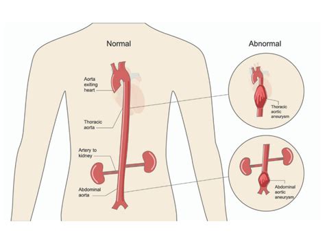 Vascular Education | My Vascular Health