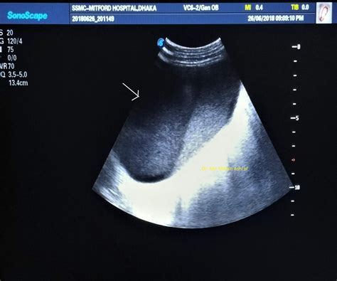 Case 07: Retroperitoneal Hematoma Ultrasound