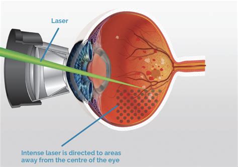 Retinal Hole Laser Treatment | Synergy Eye Care