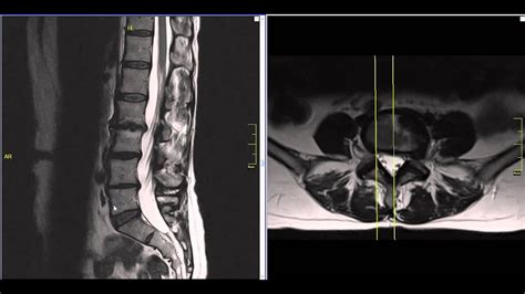 Far Lateral Lumbar Disc Herniation MRI Explained | Dr. Jeffrey P ...