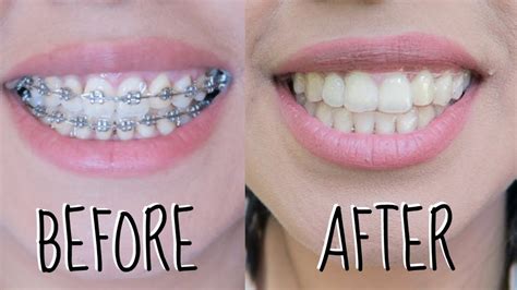 Dental Braces Before and After (New Pictures) | Teeth after braces ...