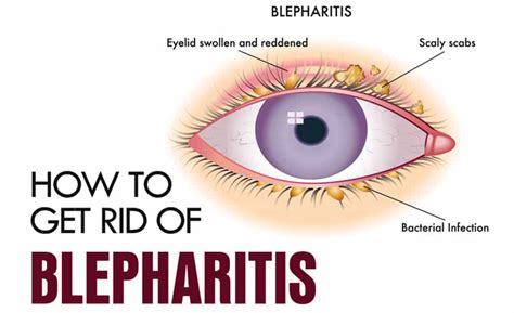 Blepharitis Home Remedies: Symptoms, Treatment, and Prevention