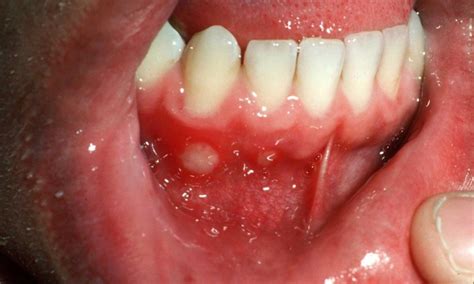 Oral Ulcers: What are the Causes and Treatments of Mouth Ulcers?