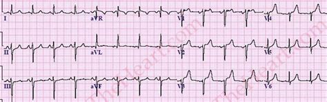 Left Anterior Fascicular Block: Who Cares? | LearntheHeart.com