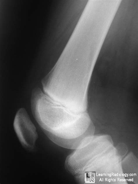 LearningRadiology - Benign, Cortical, Defect, Fibrous, Cortical, Defect ...