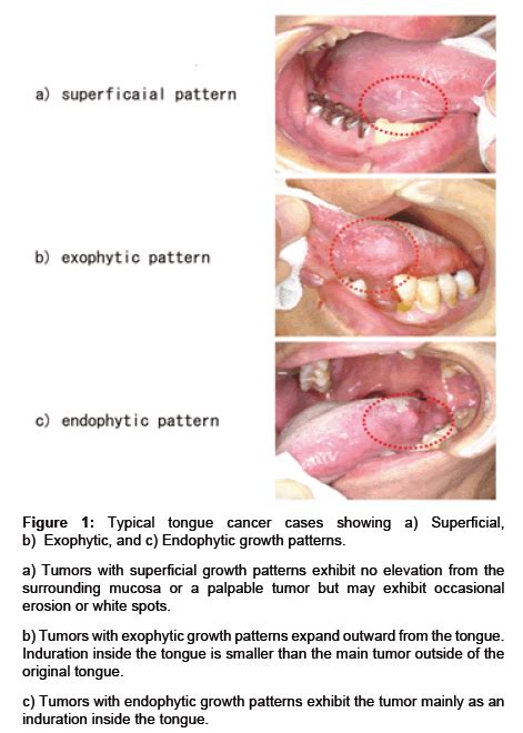 Squamous Cell Carcinoma Tongue Stage 1