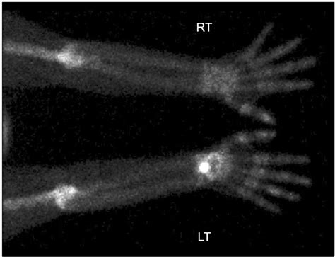 The delayed bone image of 3-phase bone scan showing increased bone ...