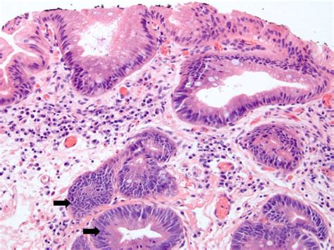 Barretts Esophagus Histology