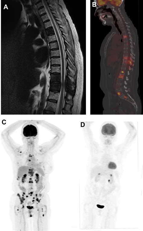 PET Imaging for Breast Cancer | Radiology Key