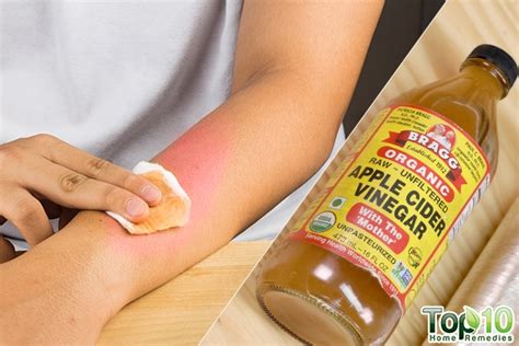 6 Apple Cider Vinegar Remedies to Heal a Skin Rash | Top 10 Home Remedies