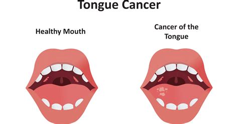 Tongue Cancer: Symptoms, Stages, Causes, Prevention and Treatment