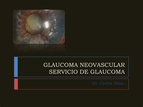 Neovascular glaucoma