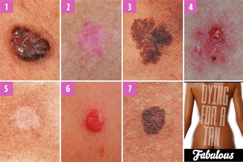 Can you spot which moles are deadly? The skin cancer signs you need to ...