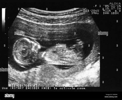 3 Month Baby Ultrasound Image - Baby Viewer