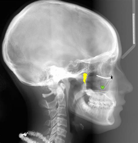 Lateral Cephalometric Skull Anatomy – Part II – Dr. G's Toothpix