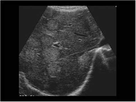 Liver Metastases Ultrasound