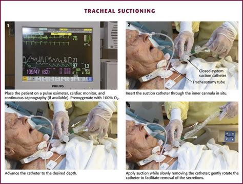 Tracheostomy Tube Suctioning