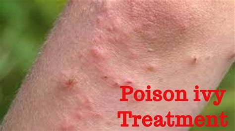 How To Treat Bad Poison Ivy Rash