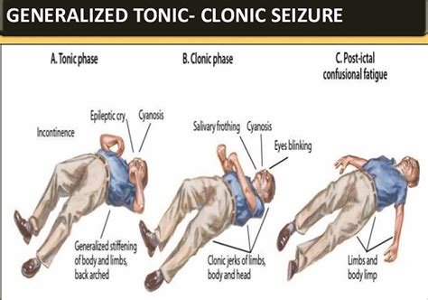 Tonic clonic seizure definition, first aid, causes, symptoms & treatment