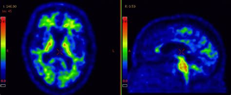 Amyloid PET imaging - The Swedish BioFINDER Study