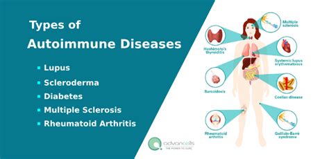 Autoimmune Diseases: Common Symptoms, Treatment in India - Advancells