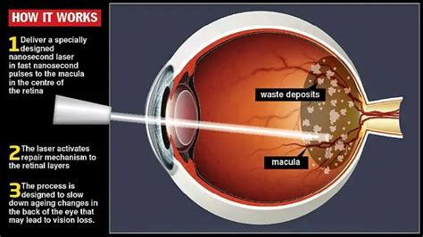 Macular Degeneration Treatment