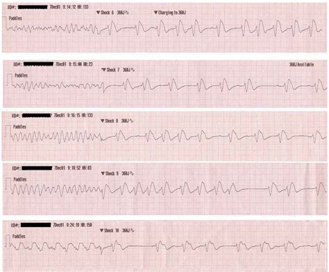 Ventricular Fibrillation (VF) • LITFL • ECG Library Diagnosis