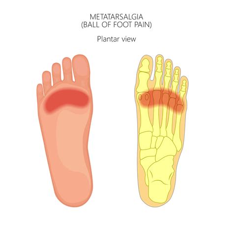 What Is Metatarsalgia? Symptoms, Causes, Treatment | Applied ...