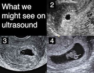 5 1 2 Weeks Pregnant Ultrasound Pictures - PictureMeta