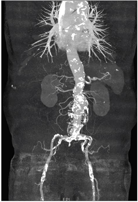 Case Report: Treatment of a Juxtarenal Aortic Aneurysm With a Relay ...