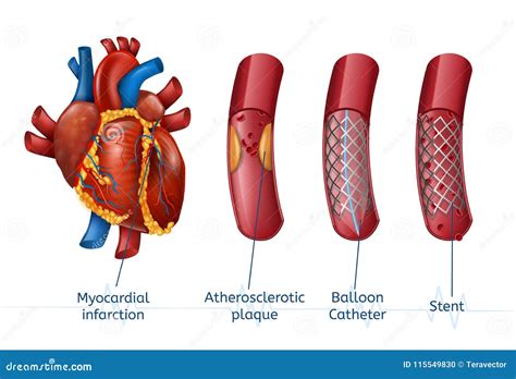 Myocardial Infarction. 3d Realostic Stent in Heart Stock Vector ...