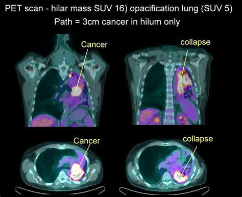 Xrays and CT Scans of Lung Cancer