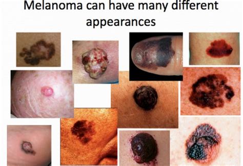 Skin Cancer - Signs Of Skin Cancer | Kimaja Farwani.