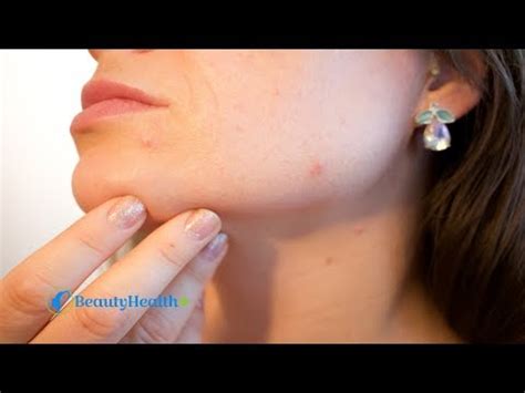 Sudocrem Acne Treatment Benefits and Instructions - BeautyHealthPlus