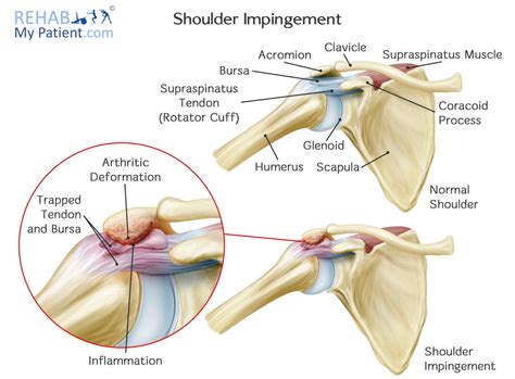 Shoulder Impingement Syndrome | Rehab My Patient