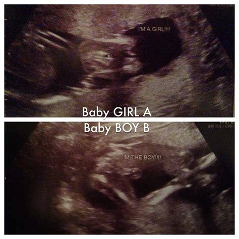 12 Week Ultrasound Girl Vs Boy