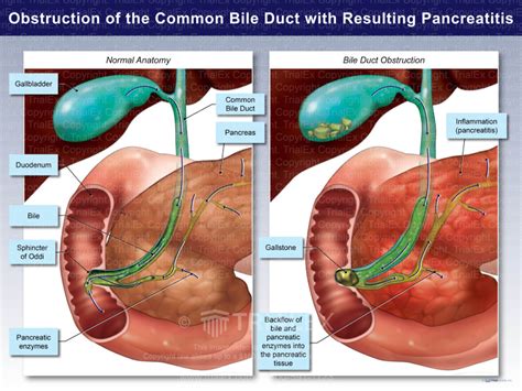 Obstruction of the Common Bile Duct with Resulting Pancreatitis ...