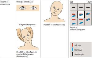 Fourth nerve palsy - WikEM